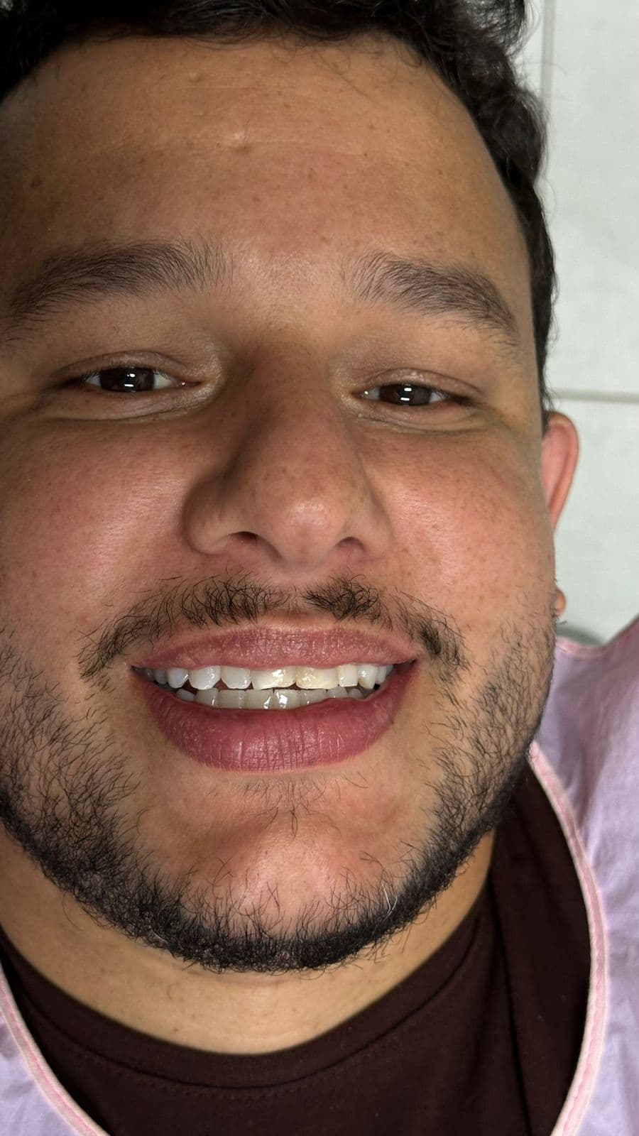 Facetas e lentes de contato dental — antes do tratamento